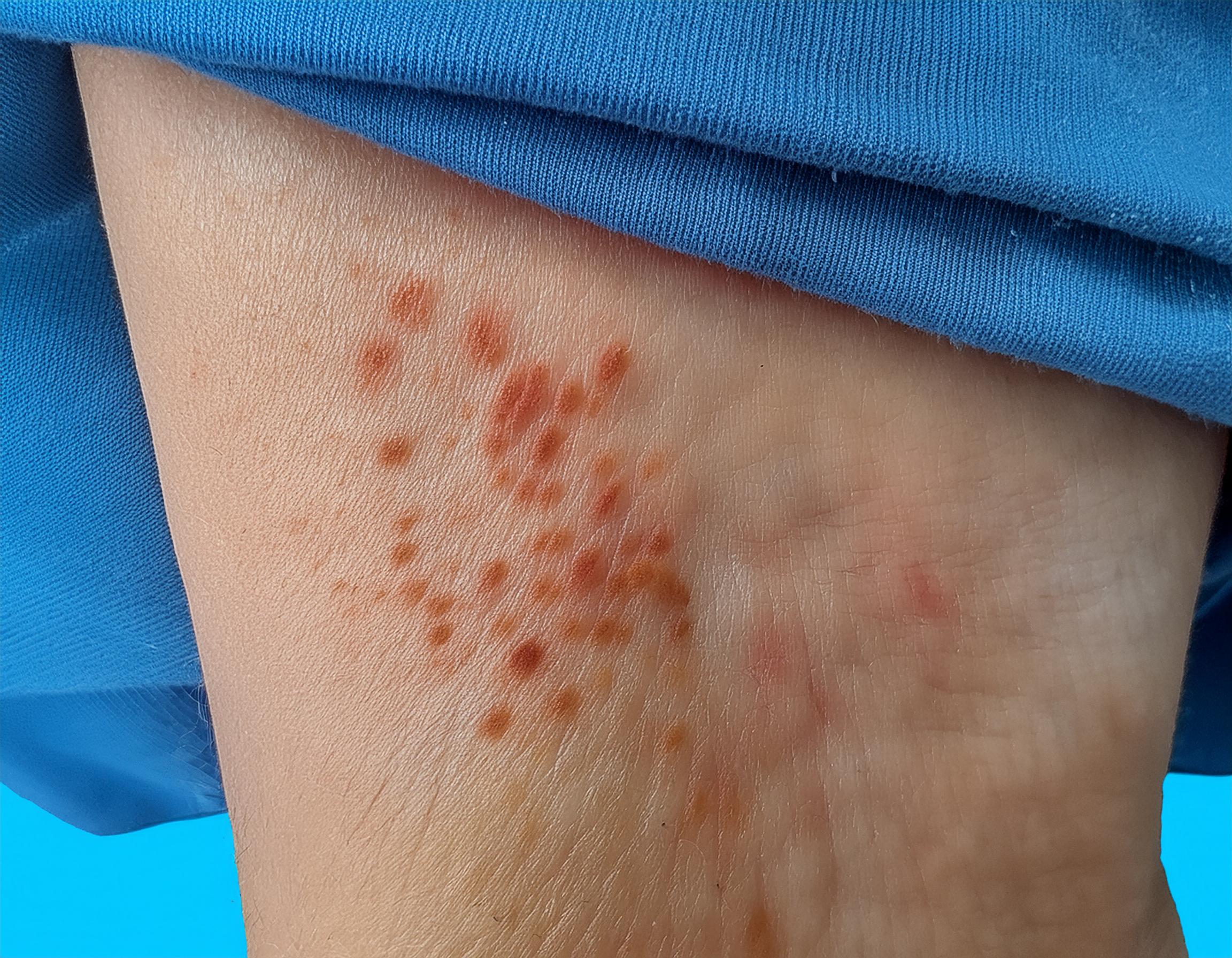 Bed Bugs control